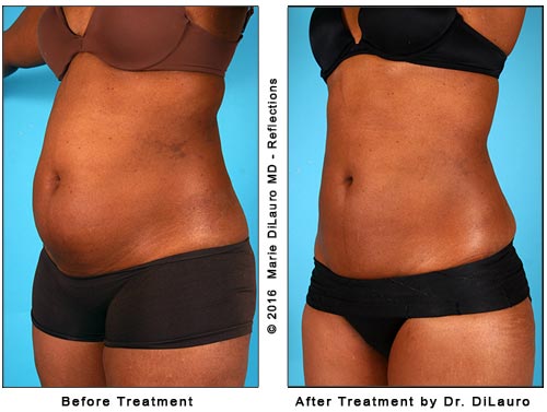 liposuction-cost-photos-results-laser-vaser-lipo-worthington-oh